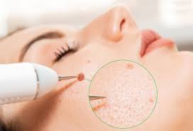 Erase Esthetics Minor Skin Irregularity Removal